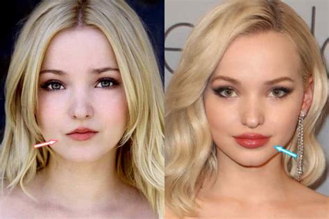 dove cameron surgery|dove cameron lip fillers.